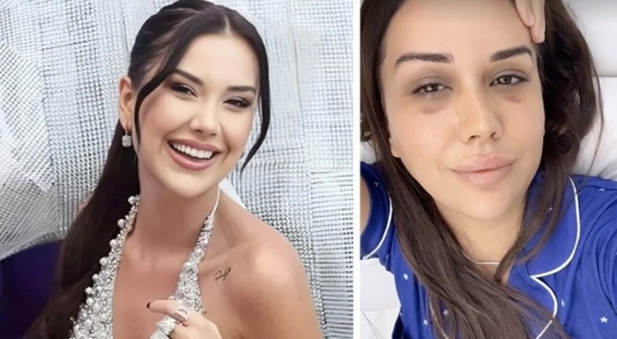 Gündem olmuştu! Dilan Polat'ın yüzündeki morlukların nedeni belli oldu