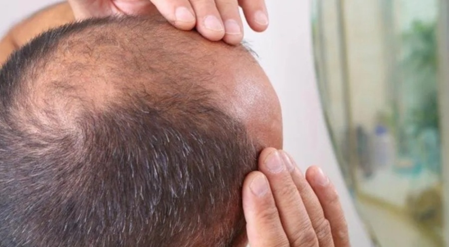 Mahkemeden emsal karar! Erkeğe kel demek cinsel taciz sayıldı