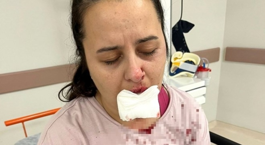 Balyozlu saldırı! Yeğeninin çenesini ve dişini kırdı