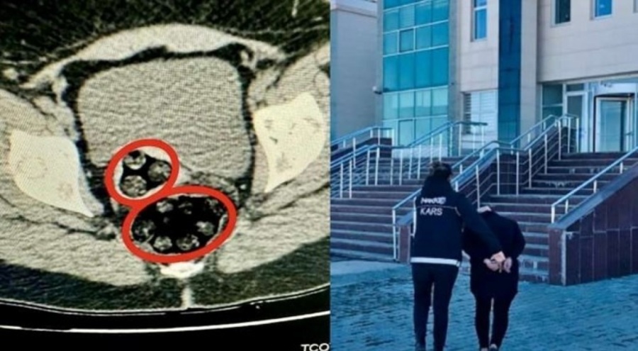 Uyuşturucu kuryesi İranlı kadın Kars'ta yakalandı! Makadına sakladı, cerrahi müdahele ile alındı