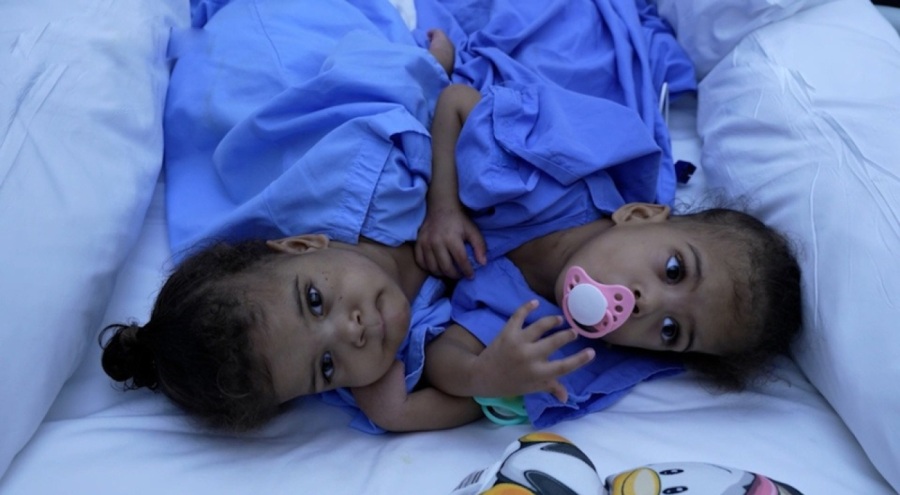 Yapışık ikizler Türkiye'de yapılan operasyonla ayrıldı