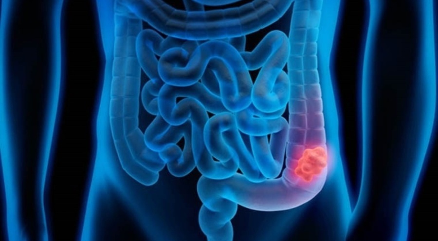 Kalın bağırsak kanserini önlemek mümkün mü?