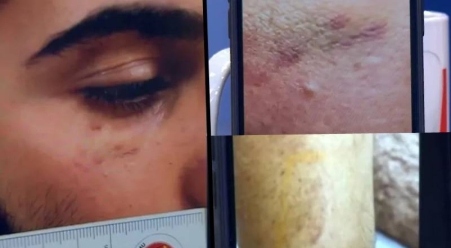 Narin'in tutuklu yargılanan ağabeyin kolundaki ısırık ve yüzündeki morluk izlerinin fotoğrafları ortaya çıktı
