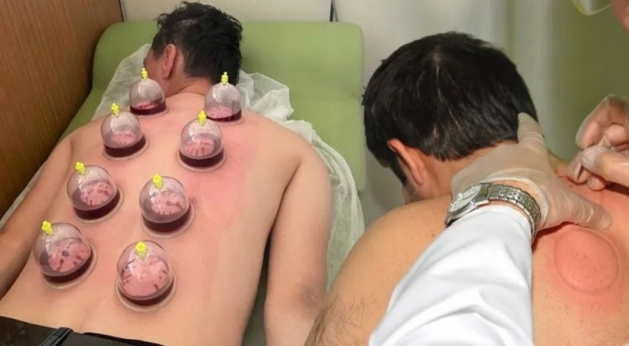 Artık aile hekimleri hacamat ve akupunktur yapacak