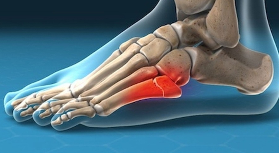 "Hastaların kanıyla kırık kemikleri tedavi edecek" implant geliştirildi