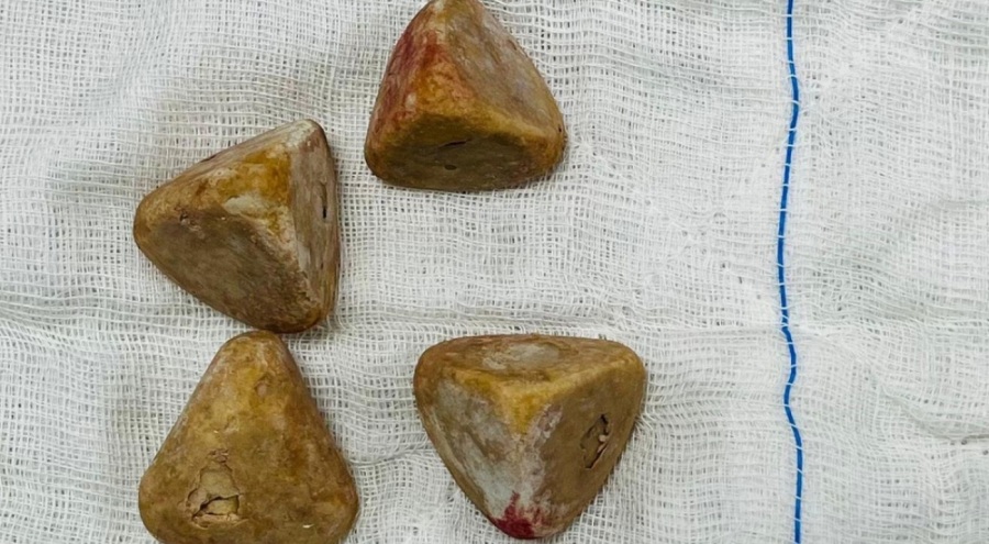 Mesanesinden piramit şeklinde dört taş çıktı