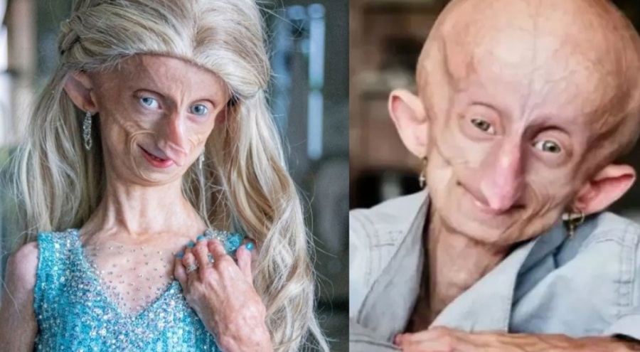 Her yıl 8 yaş yaşlanan fenomen öldü!