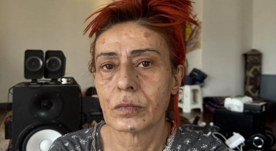 Yüzünde yanıklar oluşan Yıldız Tilbe saç boyası gerçeğini açıkladı