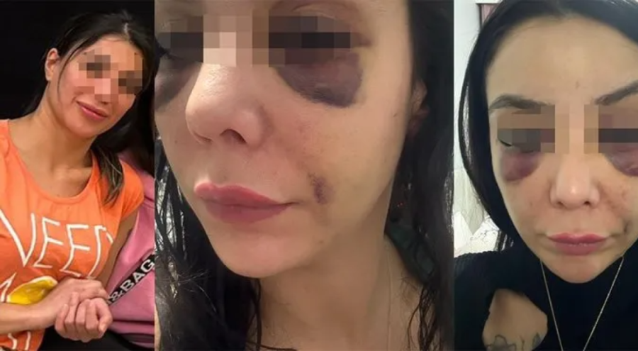 Eğlence merkezinin tuvaletinde dehşeti yaşadı! Genç kadın olay sonrası bayıldı gözleri morardı