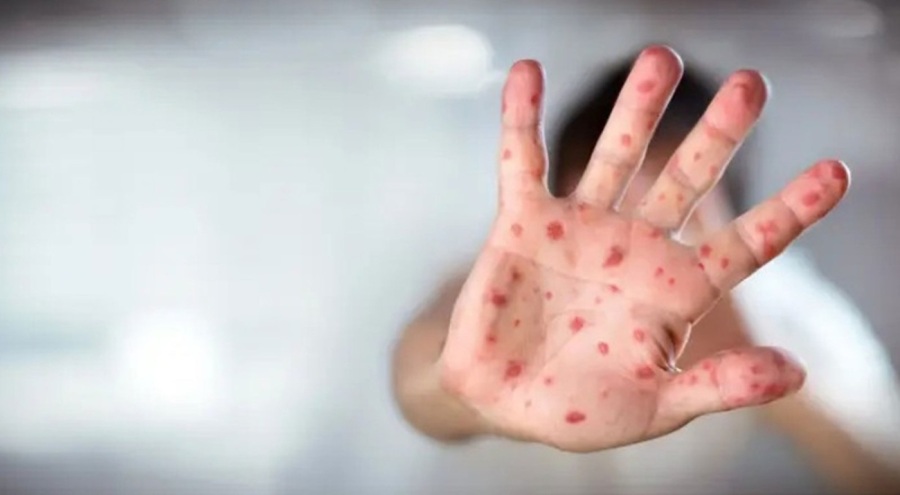 Kızamık salgınında vaka sayısı 500'e yükseldi