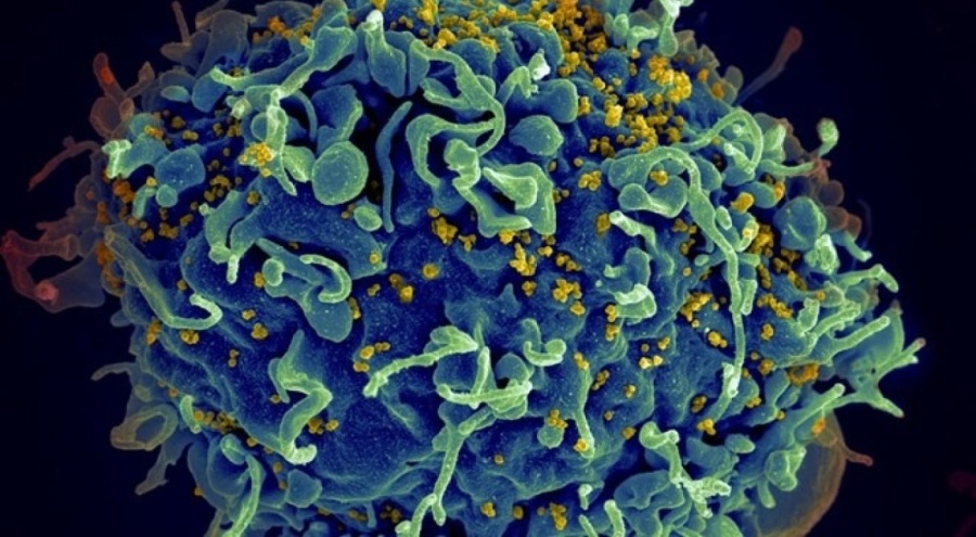 HIV tedavisinde çığır açacak adım