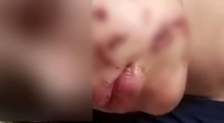 Yüzüne maytap isabet eden genç kız yaralandı