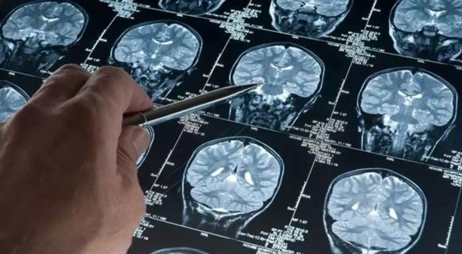 En genç Alzheimer vakası teşhis edildi