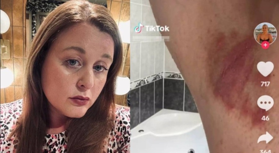 Deodorant kullanımı kabusa döndü: Cilt yanıklarıyla mücadele ediyor
