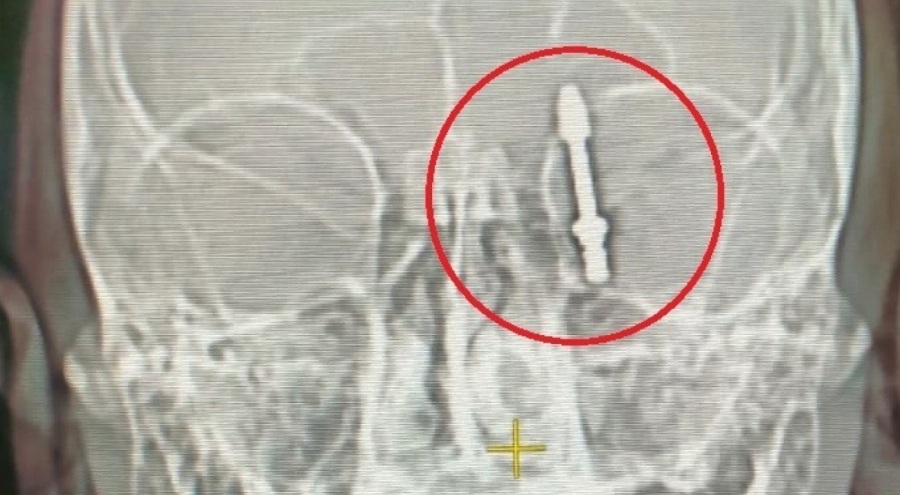 Bursa'da beynine saplanan implant hayatını kararttı!