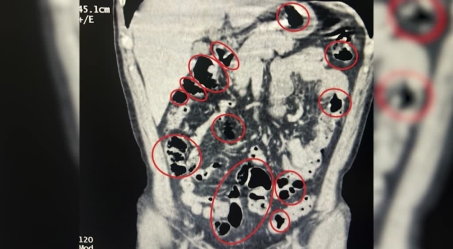 Bitlis'te mide ve bağırsaklarında uyuşturucu tespit edilen 2 şüpheli tutuklandı