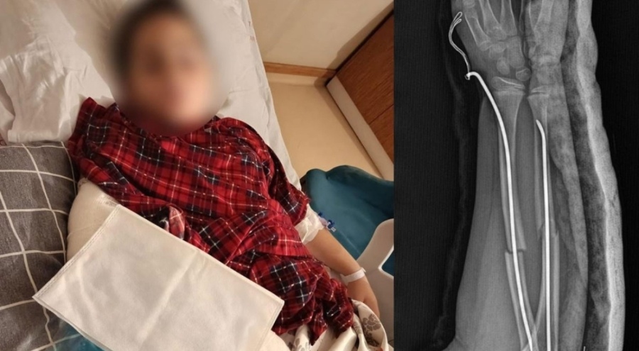 İstanbul'da akran zorbalığı: Arkadaşının kolunu 2 yerden kırdı