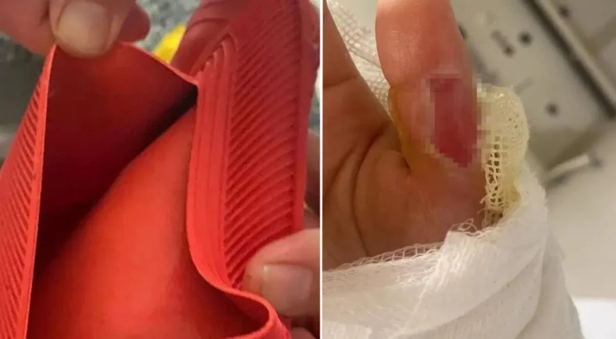 Sıcak su torbası patladı, vücudunun yüzde 25'i yandı!