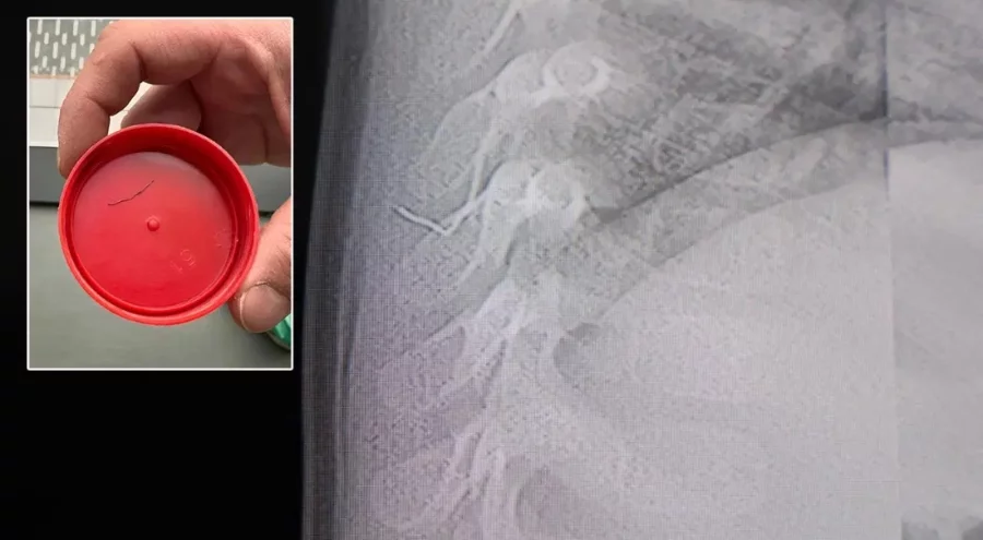 Bebeğin akciğerinden çıkan cisim şaşırttı!