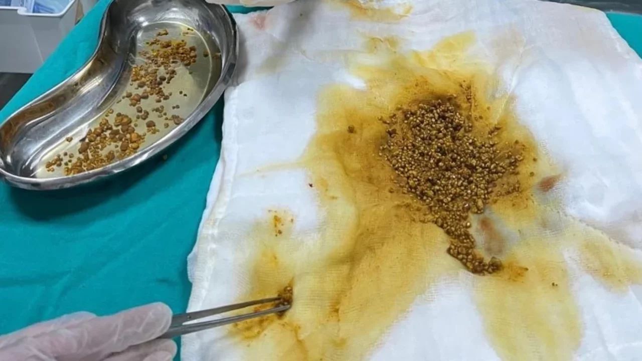 Safra kesesi ameliyatında doktoru bile şaşırtan olay!