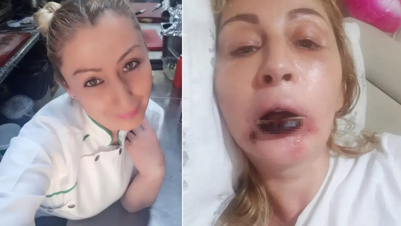 Estetik işlem sonrası dudağı çürüdü: 7 yıldır hukuk mücadelesi veriyor